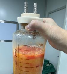 永春水动力吸脂手术要做多久？